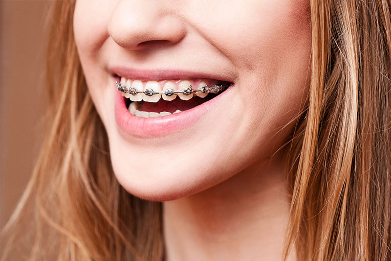 Orthodontics in Clemmons